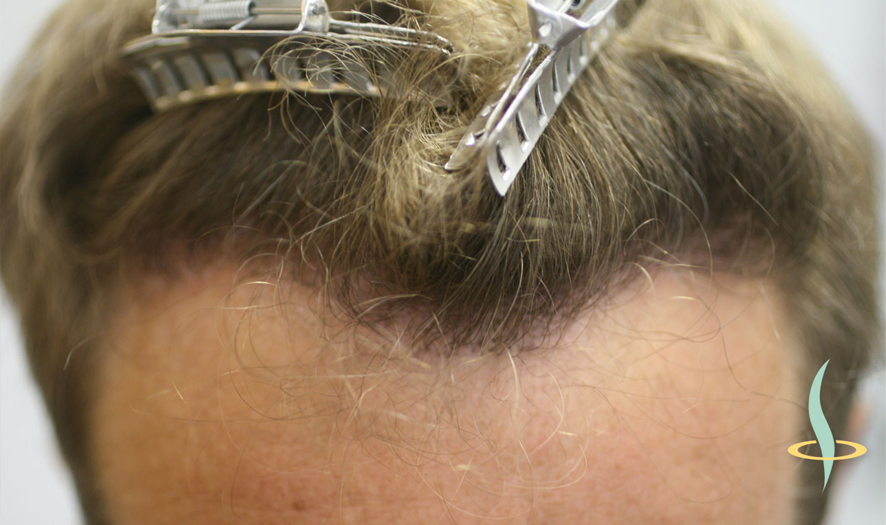صورة 11 خط منبت الشعر بعد زراعة الشعر الذاتي.