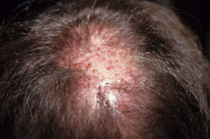 التهابات ظاهرة ونسيج به ندوب بسبب غرسات شعر صناعي في فروة رأس رجل.