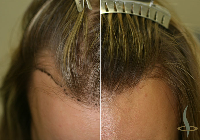 قبل وبعد العملية الثانية