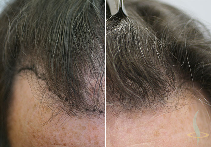 قبل العملية الثانية وبعدها