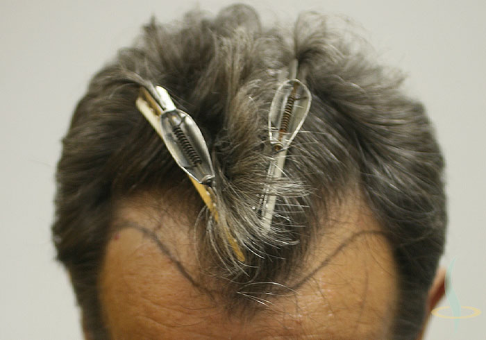 قبل العملية (مع خط الشعر)