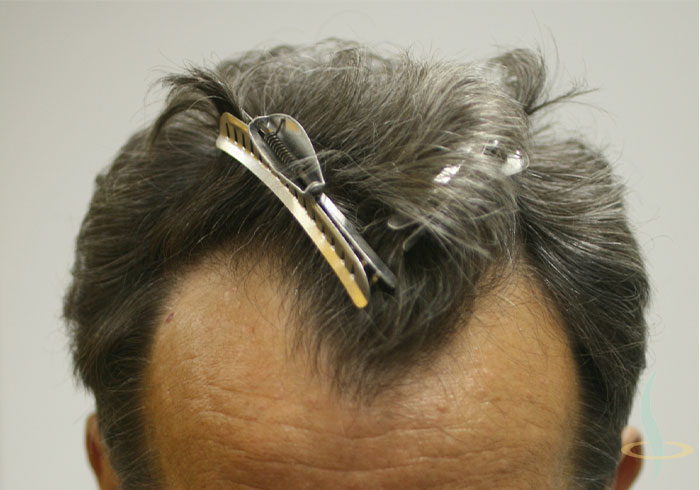 قبل العملية